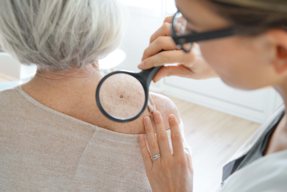 potencial dos canabinoides no câncer de pele