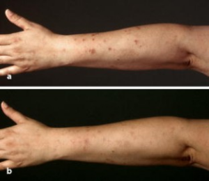 Antes e depois dos pacientes  com  líquen simples e prurido que foram tratados com um creme de cuidado contendo N-palmitoiletanolamina (PEA). Fonte: Ständer, S., Reinhardt, H.W. & Luger, T.A. Agonistas canabinóides tópicos. Dermatologista 57, 801–807 (2006).