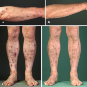 Antes e depois dos pacientes  com  líquen simples e prurido que foram tratados com um creme de cuidado contendo N-palmitoiletanolamina (PEA). Fonte: Ständer, S., Reinhardt, H.W. & Luger, T.A. Agonistas canabinóides tópicos. Dermatologista 57, 801–807 (2006).