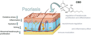 A figura destaca os possíveis mecanismos de ação do canabidiol no tratamento da psoríase. A ação do CBD pode reduzir a inflamação, o estresse oxidativo, a coceira, a proliferação anormal de queratinócitos e pode aumentar a hidratação. Adaptado de smart SERVIER MEDICAL. SISTEMA TEGUMENTAR ART. 2024. Disponível a partir de https://smart.servier.com/smart_image/integumentary-system/.