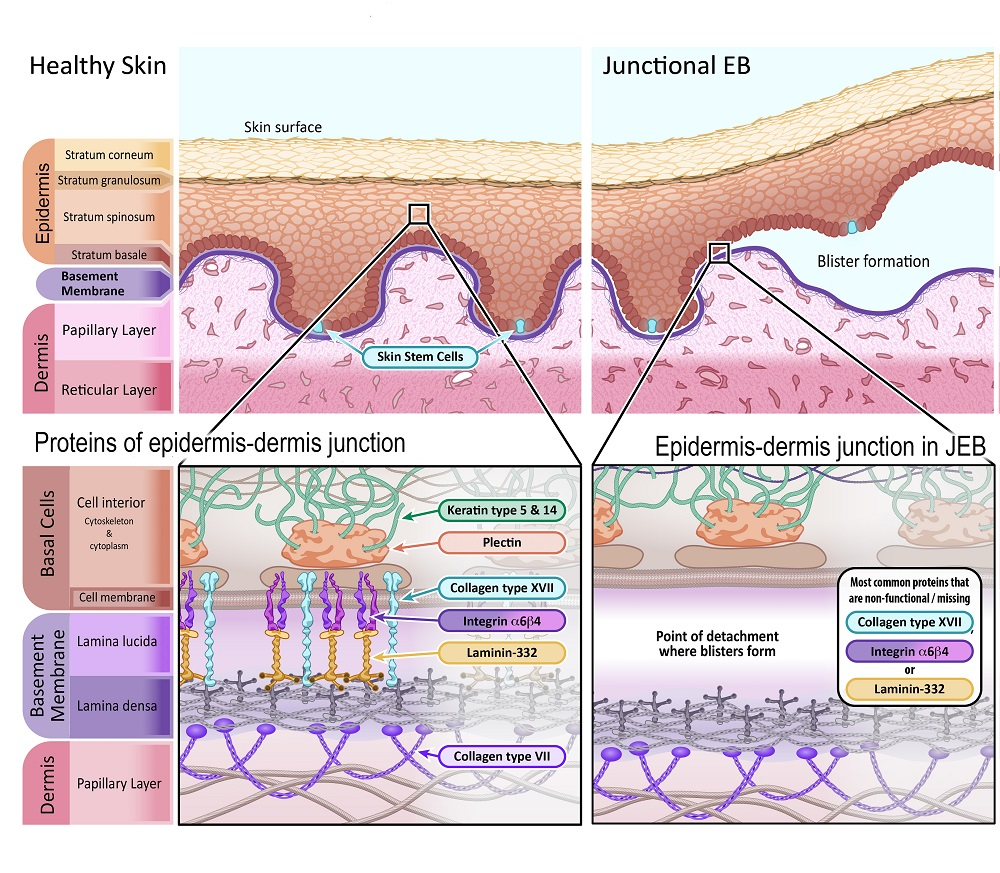 Imagem representando a pele saudável em comparação com a pele afetada pela Epidermólise Bolhosa Juncional.Fonte: EUROPEAN GENE AND CELL THERAPY CONSORTIUM (EuroGCT). Epidermolysis Bullosa: How could gene and cell therapy help? Available at: https://www.eurogct.org/epidermolysisbullosa. 