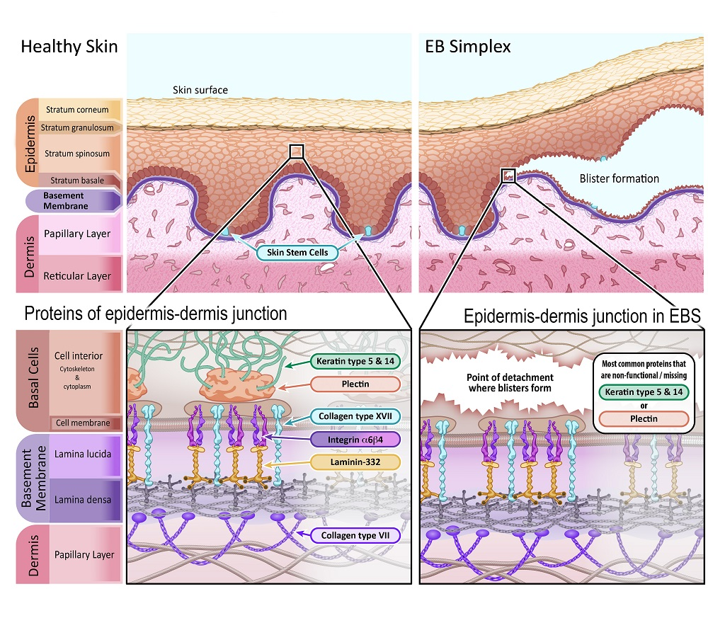 Imagem Representando a pele saudável em comparação com a pele afetada pela Epidermólise Bolhosa Simples. Fonte: EUROPEAN GENE AND CELL THERAPY CONSORTIUM (EuroGCT). Epidermolysis Bullosa: How could gene and cell therapy help? Available at: https://www.eurogct.org/epidermolysisbullosa. 