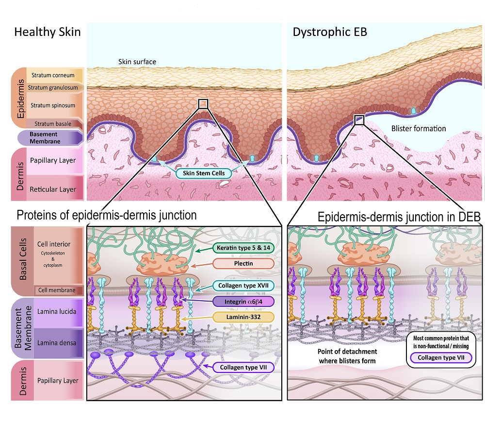 Imagem representando a pele saudável em comparação com a pele afetada pela Epidermólise Bolhosa Distrófica. Fonte: EUROPEAN GENE AND CELL THERAPY CONSORTIUM (EuroGCT). Epidermolysis Bullosa: How could gene and cell therapy help? Available at: https://www.eurogct.org/epidermolysisbullosa. 