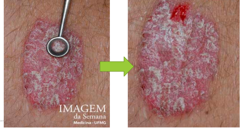 O Sinal do Orvalho Sangrante (Sinal de Auspitz). Nesta ilustração, observa-se um dermatologista utilizando uma pequena cureta para remover delicadamente as escamas presentes em uma placa psoriática. À medida que as escamas são retiradas, revela-se a derme subjacente, resultando no surgimento de pequenos pontos de sangramento, característicos do sinal do orvalho sangrante. Esse fenômeno ocorre devido à ruptura de capilares dilatados na derme papilar, evidenciando um dos achados clássicos da psoríase. Imagens Google.