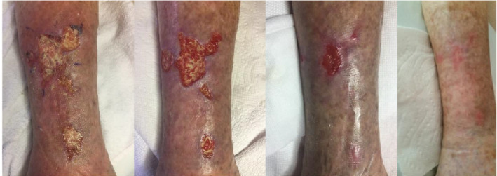 Imagens evolutivas do processo de cicatrização de ferida crônica em membro inferior do paciente de 85 anos com calcifilaxia não urêmica e múltiplas comorbidades (dias 0, 27, 54 e 74). O tratamento foi realizado com aplicações diárias de uma formulação à base de cannabis tópica (CBD 3,75mg/mL + terpenoide-𝛽-Cariofileno + flavonoides com quercetina, diosmina e hesperidina). A ferida foi completamente fechada após 74 dias de tratamento. Extraído de Maida et al. (2020a)
