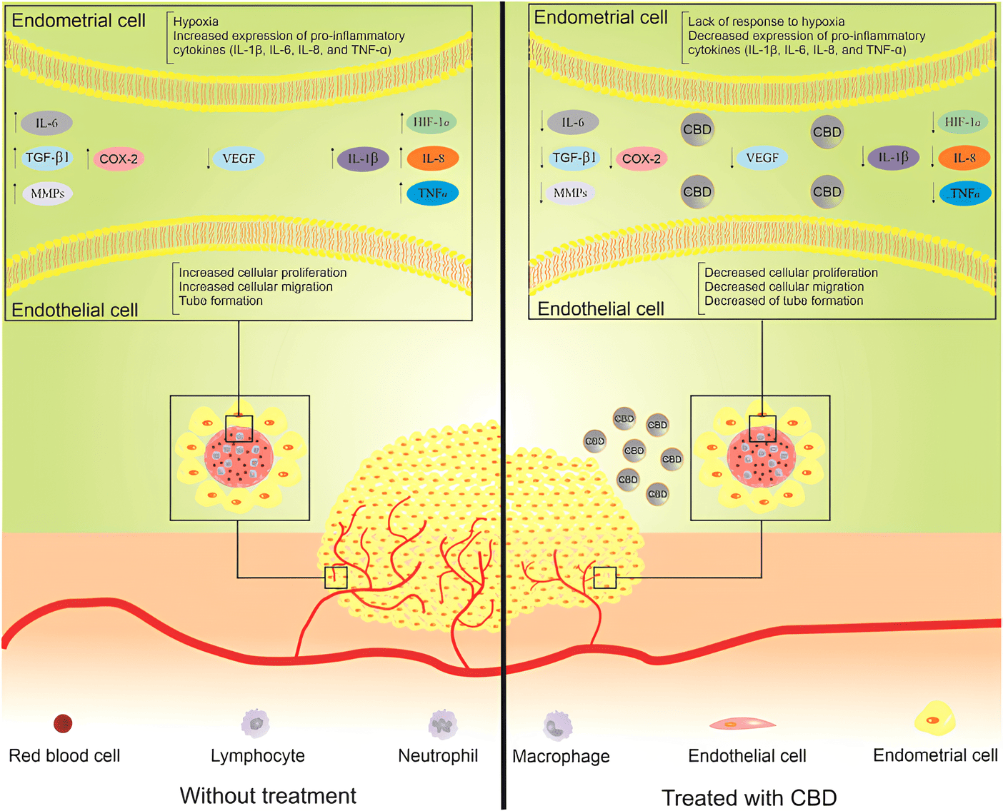 Esta figura ilustra as moléculas envolvidas na patogênese da endometriose que podem ser alvo do canabidiol. O lado esquerdo é a condição de endometriose sem tratamento e o lado direito é com o tratamento com o canabidiol. O tratamento pode reduzir o número de células endometriais por meio da inibição da angiogênese e da inflamação. CBD, canabidiol; HIF-1α, fator induzível por hipóxia 1α; IL, interleucina; MMP, metaloproteinase da matriz; TGF-β, fator de crescimento transformador β; TNF-α, fator de necrose tumoral α; VEGF, fator de crescimento endotelial vascular. Fonte: Anvari Aliabad, Roghayeh et al. “Cannabidiol as a possible treatment for endometriosis through suppression of inflammation and angiogenesis.” Immunity, inflammation and disease vol. 12,8 (2024).