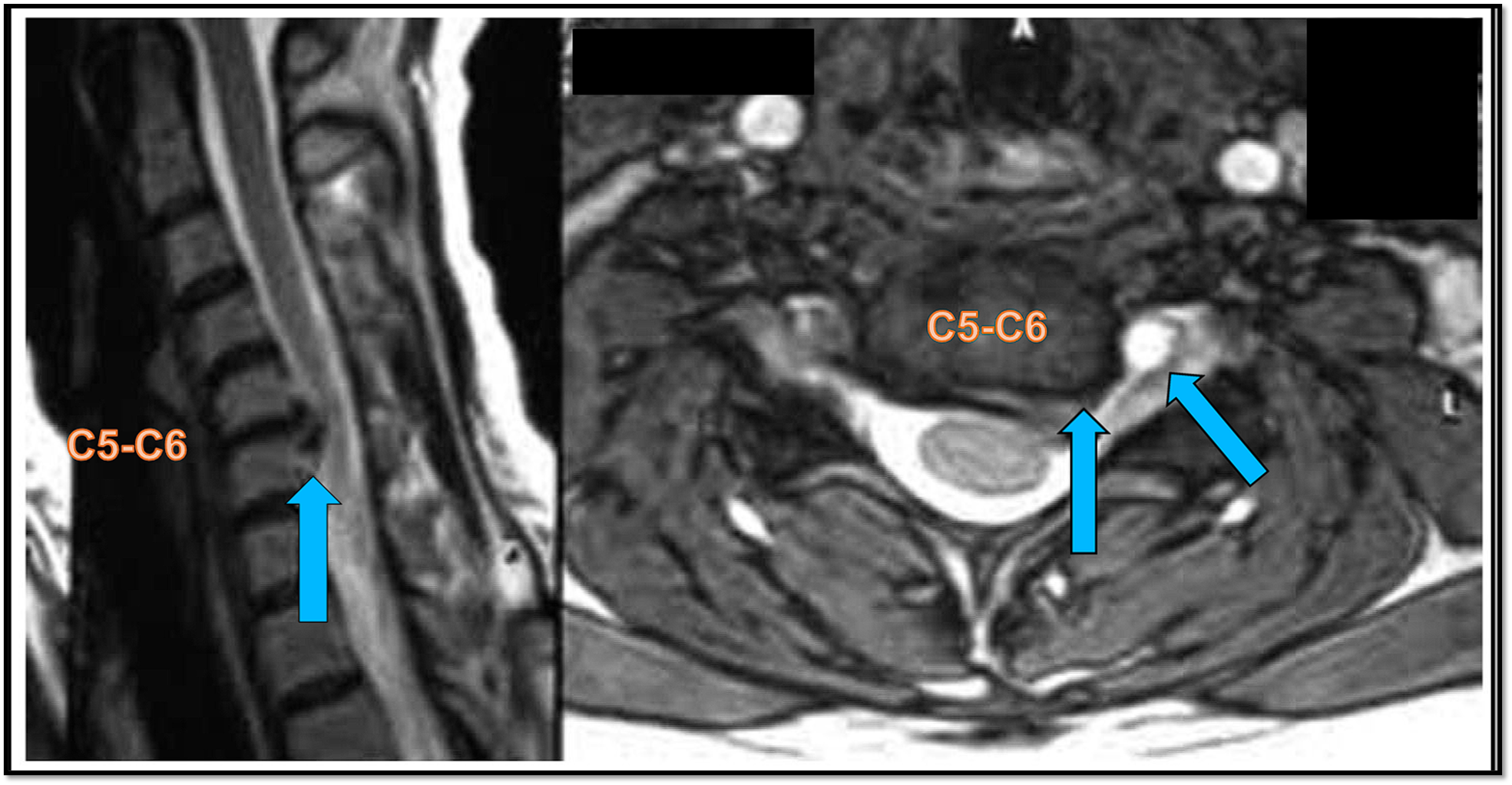 Ressonância magnética (RM) cervical, com uma hérnia de disco cervical póstero-lateral esquerda entre as vértebras C5-C6, com edema radicular em C6, comprimindo a raiz nervosa,