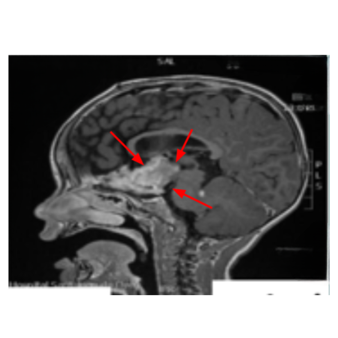 RNM do encéfalo em corte sagital.