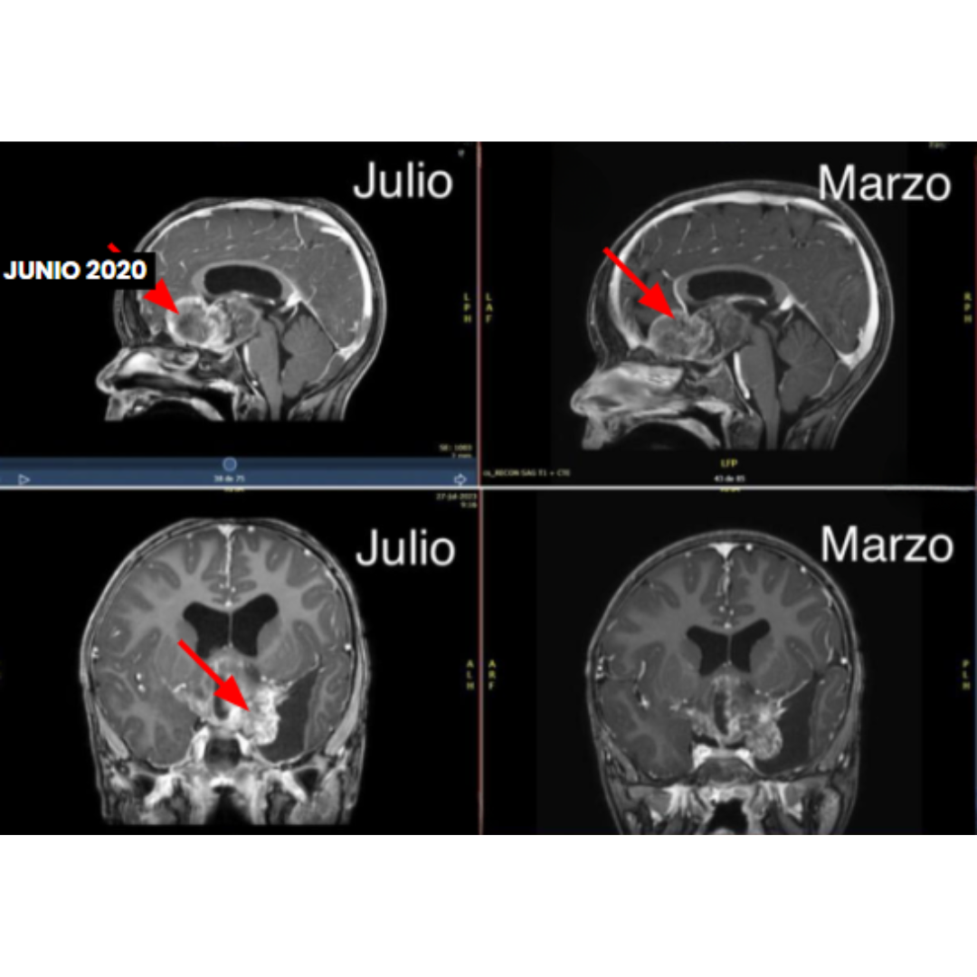 RNM do encéfalo em cortes sagital e coronal