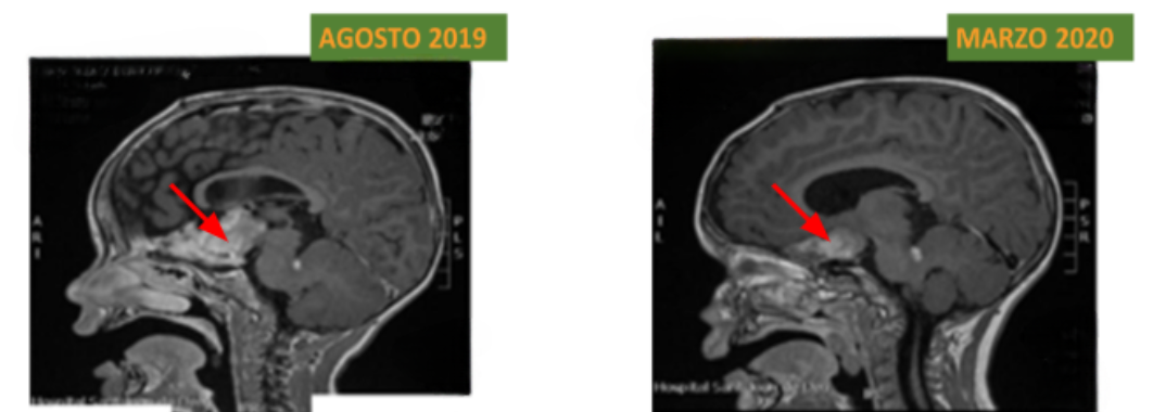 RNM do encéfalo em corte sagital.