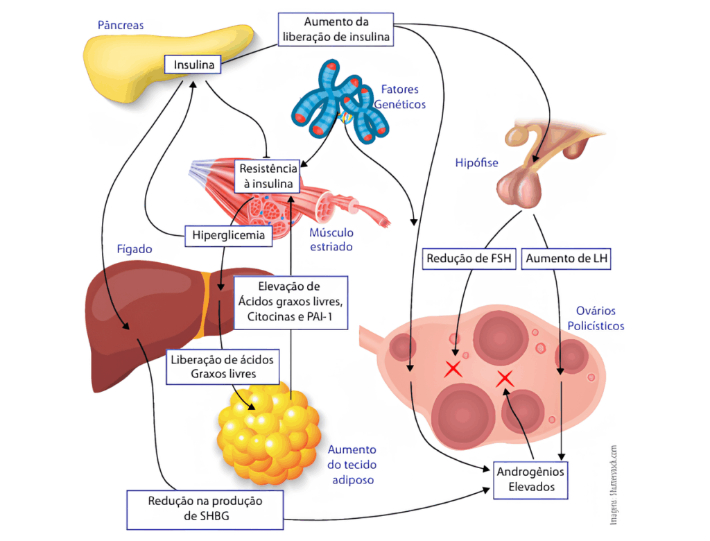 Resumo dos possíveis fatores envolvidos na gênese da SOP. Fonte: Modificado de Nestler JE. Metformin for the treatment of the polycystic ovary syndrome. N Engl J Med. 2008; 358(1):47-54.(19)