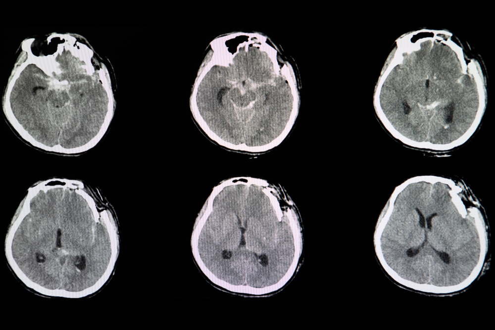 cannabis e traumatismo crânio-encefálico