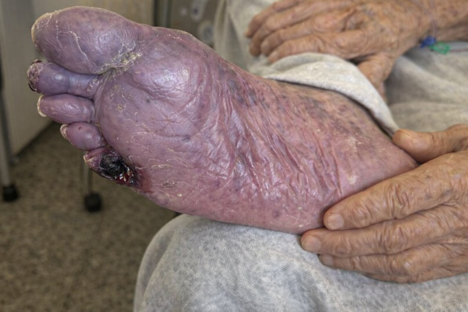 Pé esquerdo do paciente com presença de lesão trófica em dorso com áreas de necrose seca